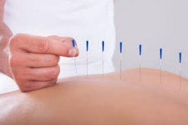 Acupunture